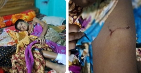 নারায়নগন্জ সিদ্ধিরগঞ্জে পাগলা কুকুরের কামড়ে তিন শিশু আহত